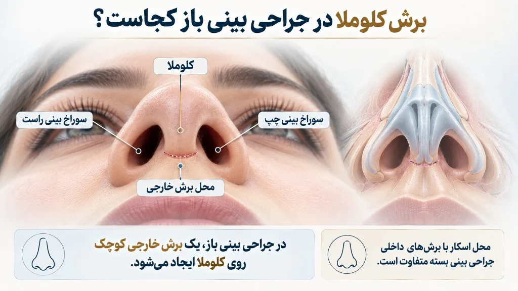 برش کلوملا در جراحی بینی باز کجاست؟