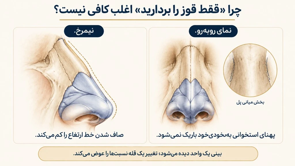 اثر کاهش ارتفاع روی پهنا و بخش میانی