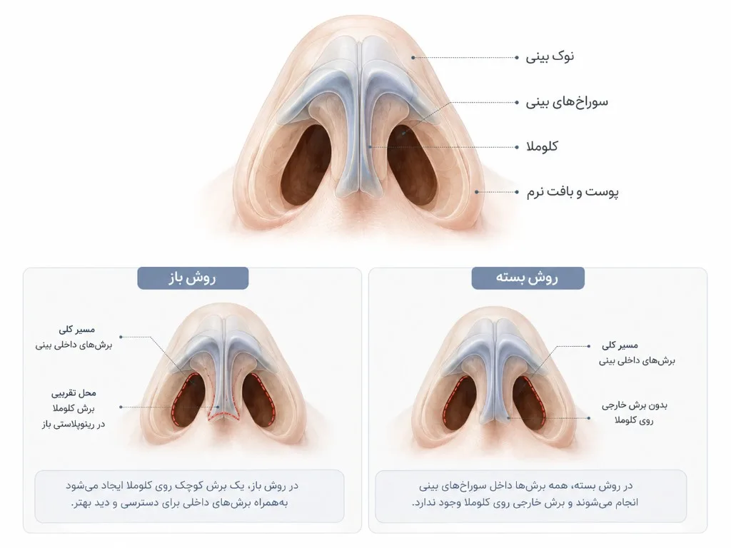 آناتومی پایه بینی و محل برش