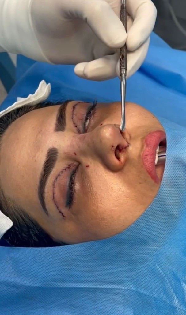 بررسی بینی بیمار در حین عمل؛ جراحی بینی همراه با بلفاروپلاستی.