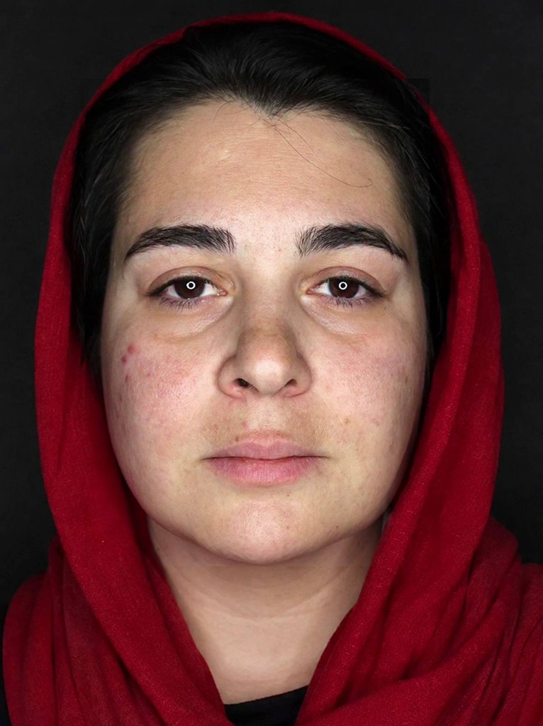 قبل — نتیجه جراحی زیبایی بینی — نمونه ۲