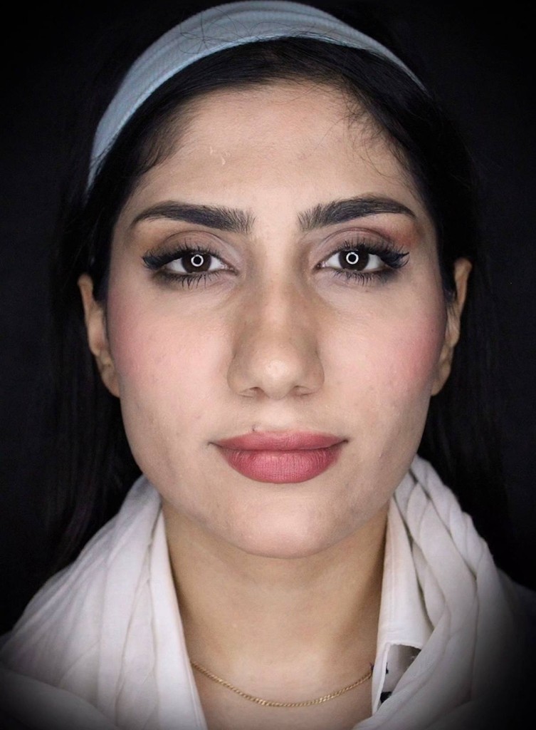قبل — نتیجه جراحی زیبایی بینی — نمونه ۳