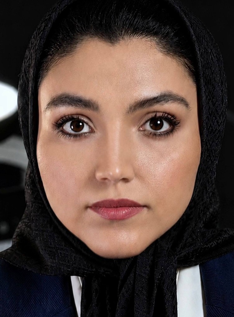 بعد — نتیجه جراحی زیبایی بینی — نمونه ۴