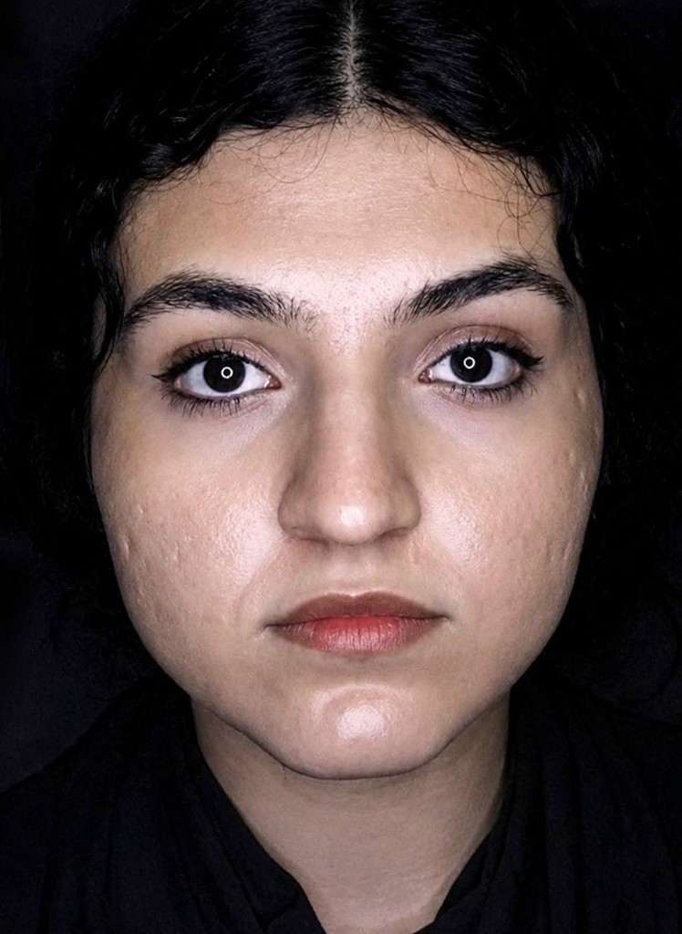 قبل — نتیجه جراحی زیبایی بینی — نمونه ۴