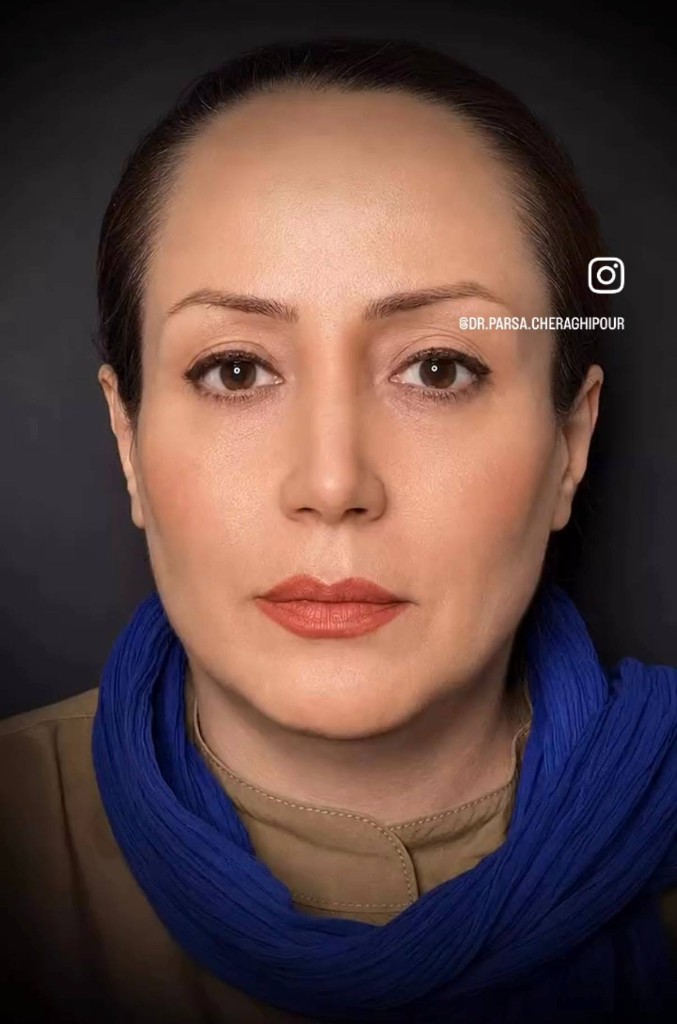 بعد — نتیجه جراحی زیبایی بینی — نمونه ۷