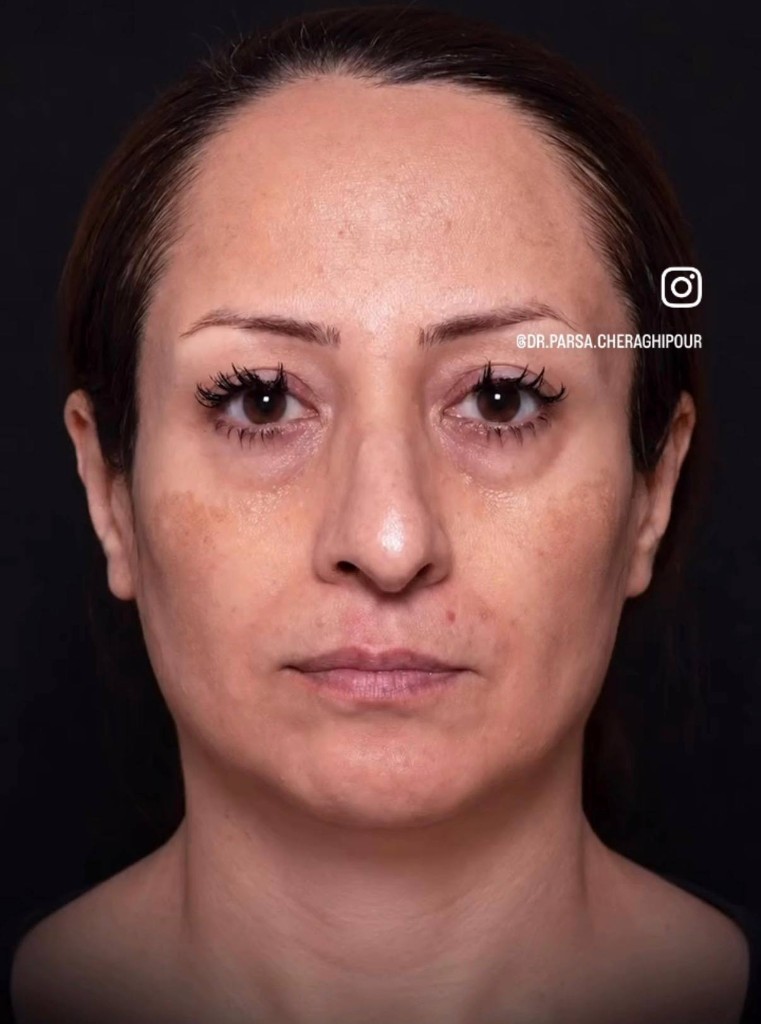 قبل — نتیجه جراحی زیبایی بینی — نمونه ۷