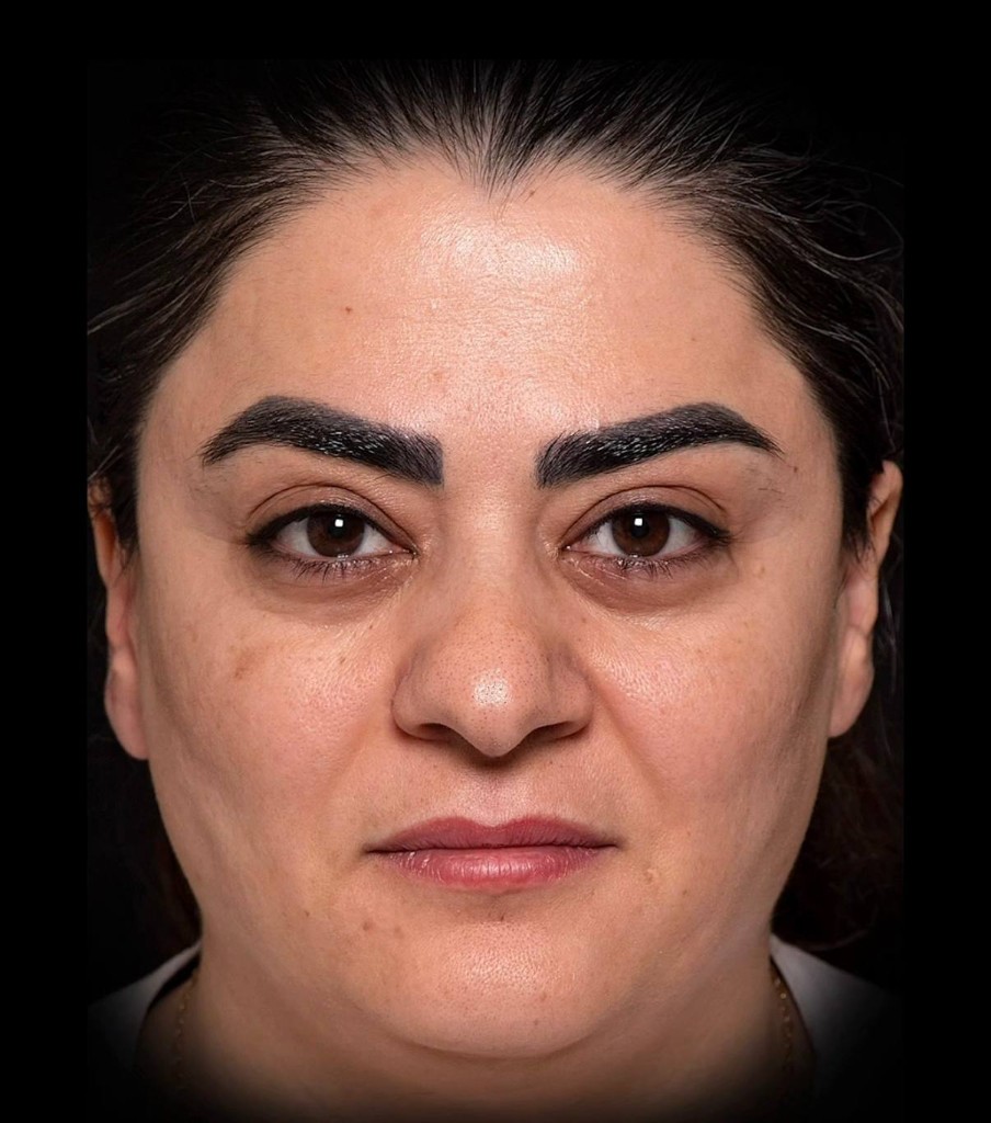 قبل — نتیجه جراحی زیبایی بینی — نمونه ۸